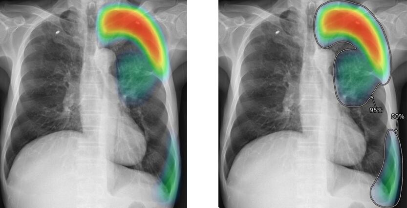 Anomaly detection in MRI images